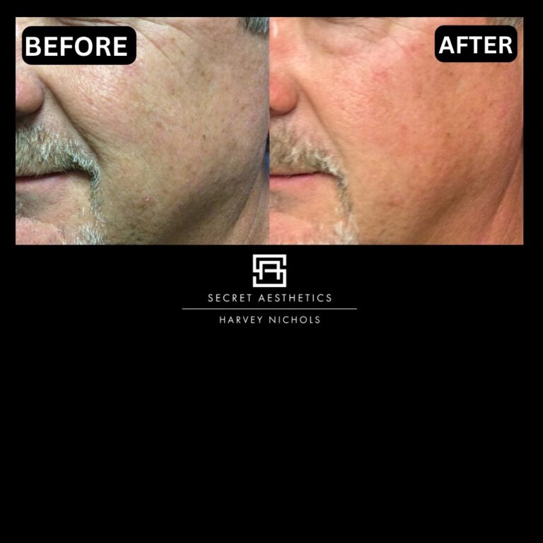Radiofrequency microneedling results, Radiofrequency microneedling before and after, Radiofrequency microneedling treatment, Radiofrequency microneedling birmingham, aesthetics clinic birmingham, skin clinic birmingham, secret aesthetics birmingham, harvey nichols birmingham, the mailbox birmingham, the mailbox aesthetics clinic, the mailbox skin clinic, harvey nichols aesthetic clinic, harvey nichols skin clinic, General Anti-Ageing, Scars, Skin quality, laxity, texture and appearance Stretch Marks, stretch mark removal, sun damage removal, freckle removal, wrinkle treatment, skin resurfacing, scar removal