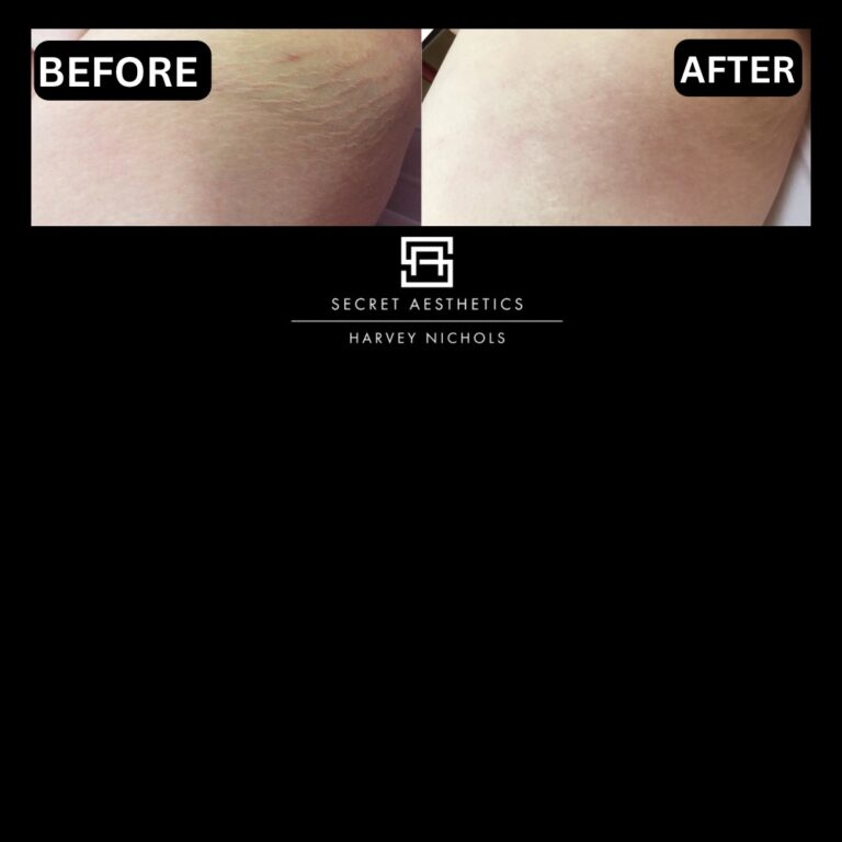 Radiofrequency microneedling results, Radiofrequency microneedling before and after, Radiofrequency microneedling treatment, Radiofrequency microneedling birmingham, aesthetics clinic birmingham, skin clinic birmingham, secret aesthetics birmingham, harvey nichols birmingham, the mailbox birmingham, the mailbox aesthetics clinic, the mailbox skin clinic, harvey nichols aesthetic clinic, harvey nichols skin clinic, General Anti-Ageing, Scars, Skin quality, laxity, texture and appearance Stretch Marks, stretch mark removal, sun damage removal, freckle removal, wrinkle treatment, skin resurfacing, scar removal