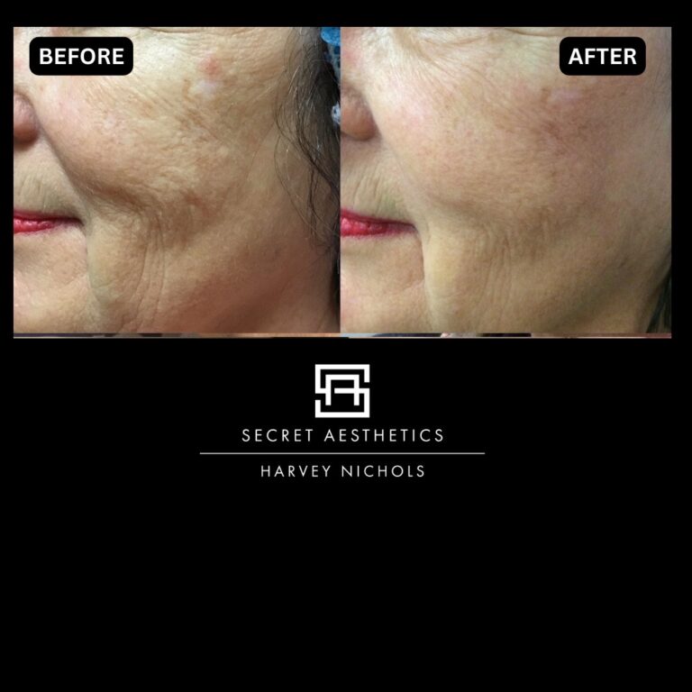 Radiofrequency microneedling results, Radiofrequency microneedling before and after, Radiofrequency microneedling treatment, Radiofrequency microneedling birmingham, aesthetics clinic birmingham, skin clinic birmingham, secret aesthetics birmingham, harvey nichols birmingham, the mailbox birmingham, the mailbox aesthetics clinic, the mailbox skin clinic, harvey nichols aesthetic clinic, harvey nichols skin clinic, General Anti-Ageing, Scars, Skin quality, laxity, texture and appearance Stretch Marks, stretch mark removal, sun damage removal, freckle removal, wrinkle treatment, skin resurfacing, scar removal