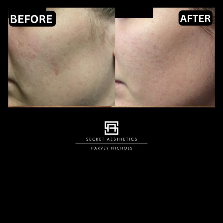 Radiofrequency microneedling results, Radiofrequency microneedling before and after, Radiofrequency microneedling treatment, Radiofrequency microneedling birmingham, aesthetics clinic birmingham, skin clinic birmingham, secret aesthetics birmingham, harvey nichols birmingham, the mailbox birmingham, the mailbox aesthetics clinic, the mailbox skin clinic, harvey nichols aesthetic clinic, harvey nichols skin clinic, General Anti-Ageing, Scars, Skin quality, laxity, texture and appearance Stretch Marks, stretch mark removal, sun damage removal, freckle removal, wrinkle treatment, skin resurfacing, scar removal