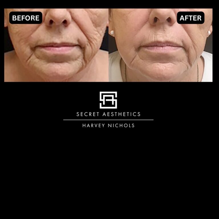 Radiofrequency microneedling results, Radiofrequency microneedling before and after, Radiofrequency microneedling treatment, Radiofrequency microneedling birmingham, aesthetics clinic birmingham, skin clinic birmingham, secret aesthetics birmingham, harvey nichols birmingham, the mailbox birmingham, the mailbox aesthetics clinic, the mailbox skin clinic, harvey nichols aesthetic clinic, harvey nichols skin clinic, General Anti-Ageing, Scars, Skin quality, laxity, texture and appearance Stretch Marks, stretch mark removal, sun damage removal, freckle removal, wrinkle treatment, skin resurfacing, scar removal