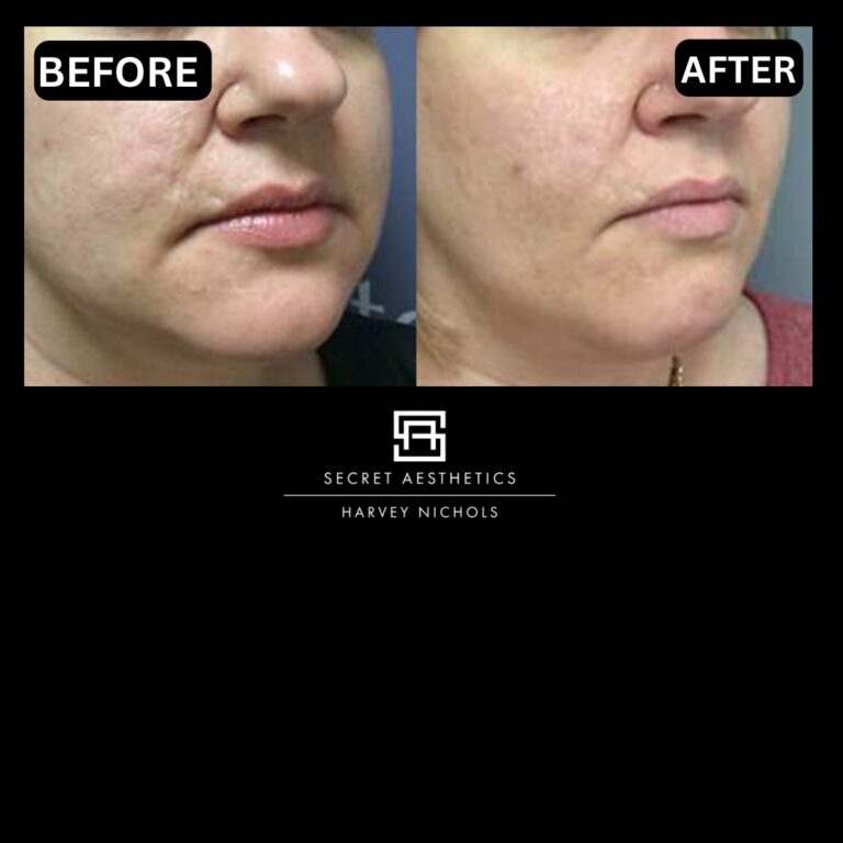 Radiofrequency microneedling results, Radiofrequency microneedling before and after, Radiofrequency microneedling treatment, Radiofrequency microneedling birmingham, aesthetics clinic birmingham, skin clinic birmingham, secret aesthetics birmingham, harvey nichols birmingham, the mailbox birmingham, the mailbox aesthetics clinic, the mailbox skin clinic, harvey nichols aesthetic clinic, harvey nichols skin clinic, General Anti-Ageing, Scars, Skin quality, laxity, texture and appearance Stretch Marks, stretch mark removal, sun damage removal, freckle removal, wrinkle treatment, skin resurfacing, scar removal