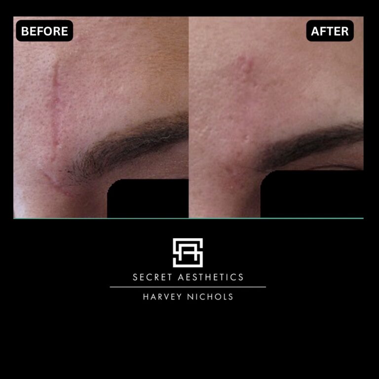 Radiofrequency microneedling results, Radiofrequency microneedling before and after, Radiofrequency microneedling treatment, Radiofrequency microneedling birmingham, aesthetics clinic birmingham, skin clinic birmingham, secret aesthetics birmingham, harvey nichols birmingham, the mailbox birmingham, the mailbox aesthetics clinic, the mailbox skin clinic, harvey nichols aesthetic clinic, harvey nichols skin clinic, General Anti-Ageing, Scars, Skin quality, laxity, texture and appearance Stretch Marks, stretch mark removal, sun damage removal, freckle removal, wrinkle treatment, skin resurfacing, scar removal