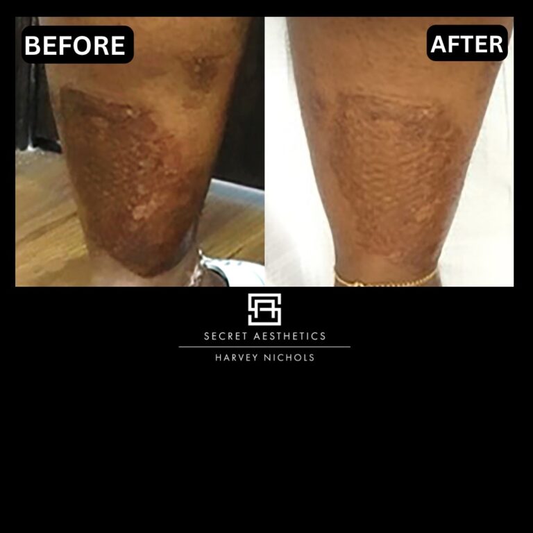 Radiofrequency microneedling results, Radiofrequency microneedling before and after, Radiofrequency microneedling treatment, Radiofrequency microneedling birmingham, aesthetics clinic birmingham, skin clinic birmingham, secret aesthetics birmingham, harvey nichols birmingham, the mailbox birmingham, the mailbox aesthetics clinic, the mailbox skin clinic, harvey nichols aesthetic clinic, harvey nichols skin clinic, General Anti-Ageing, Scars, Skin quality, laxity, texture and appearance Stretch Marks, stretch mark removal, sun damage removal, freckle removal, wrinkle treatment, skin resurfacing, scar removal