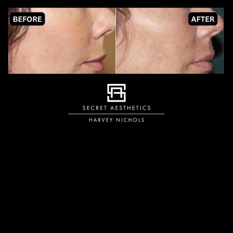 Radiofrequency microneedling results, Radiofrequency microneedling before and after, Radiofrequency microneedling treatment, Radiofrequency microneedling birmingham, aesthetics clinic birmingham, skin clinic birmingham, secret aesthetics birmingham, harvey nichols birmingham, the mailbox birmingham, the mailbox aesthetics clinic, the mailbox skin clinic, harvey nichols aesthetic clinic, harvey nichols skin clinic, General Anti-Ageing, Scars, Skin quality, laxity, texture and appearance Stretch Marks, stretch mark removal, sun damage removal, freckle removal, wrinkle treatment, skin resurfacing, scar removal