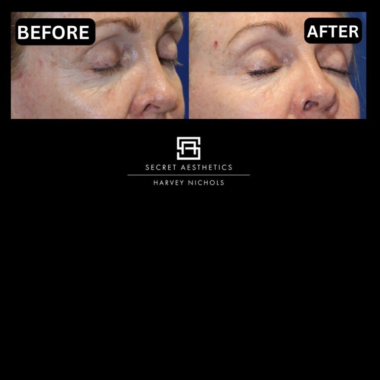 Radiofrequency microneedling results, Radiofrequency microneedling before and after, Radiofrequency microneedling treatment, Radiofrequency microneedling birmingham, aesthetics clinic birmingham, skin clinic birmingham, secret aesthetics birmingham, harvey nichols birmingham, the mailbox birmingham, the mailbox aesthetics clinic, the mailbox skin clinic, harvey nichols aesthetic clinic, harvey nichols skin clinic, General Anti-Ageing, Scars, Skin quality, laxity, texture and appearance Stretch Marks, stretch mark removal, sun damage removal, freckle removal, wrinkle treatment, skin resurfacing, scar removal