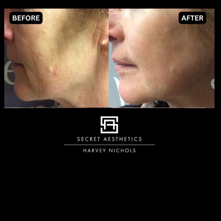 Radiofrequency microneedling results, Radiofrequency microneedling before and after, Radiofrequency microneedling treatment, Radiofrequency microneedling birmingham, aesthetics clinic birmingham, skin clinic birmingham, secret aesthetics birmingham, harvey nichols birmingham, the mailbox birmingham, the mailbox aesthetics clinic, the mailbox skin clinic, harvey nichols aesthetic clinic, harvey nichols skin clinic, General Anti-Ageing, Scars, Skin quality, laxity, texture and appearance Stretch Marks, stretch mark removal, sun damage removal, freckle removal, wrinkle treatment, skin resurfacing, scar removal