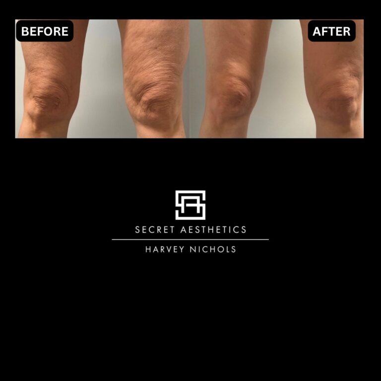 Radiofrequency microneedling results, Radiofrequency microneedling before and after, Radiofrequency microneedling treatment, Radiofrequency microneedling birmingham, aesthetics clinic birmingham, skin clinic birmingham, secret aesthetics birmingham, harvey nichols birmingham, the mailbox birmingham, the mailbox aesthetics clinic, the mailbox skin clinic, harvey nichols aesthetic clinic, harvey nichols skin clinic, General Anti-Ageing, Scars, Skin quality, laxity, texture and appearance Stretch Marks, stretch mark removal, sun damage removal, freckle removal, wrinkle treatment, skin resurfacing, scar removal