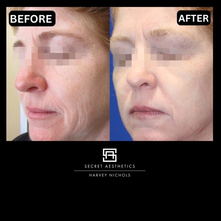 Radiofrequency microneedling results, Radiofrequency microneedling before and after, Radiofrequency microneedling treatment, Radiofrequency microneedling birmingham, aesthetics clinic birmingham, skin clinic birmingham, secret aesthetics birmingham, harvey nichols birmingham, the mailbox birmingham, the mailbox aesthetics clinic, the mailbox skin clinic, harvey nichols aesthetic clinic, harvey nichols skin clinic, General Anti-Ageing, Scars, Skin quality, laxity, texture and appearance Stretch Marks, stretch mark removal, sun damage removal, freckle removal, wrinkle treatment, skin resurfacing, scar removal