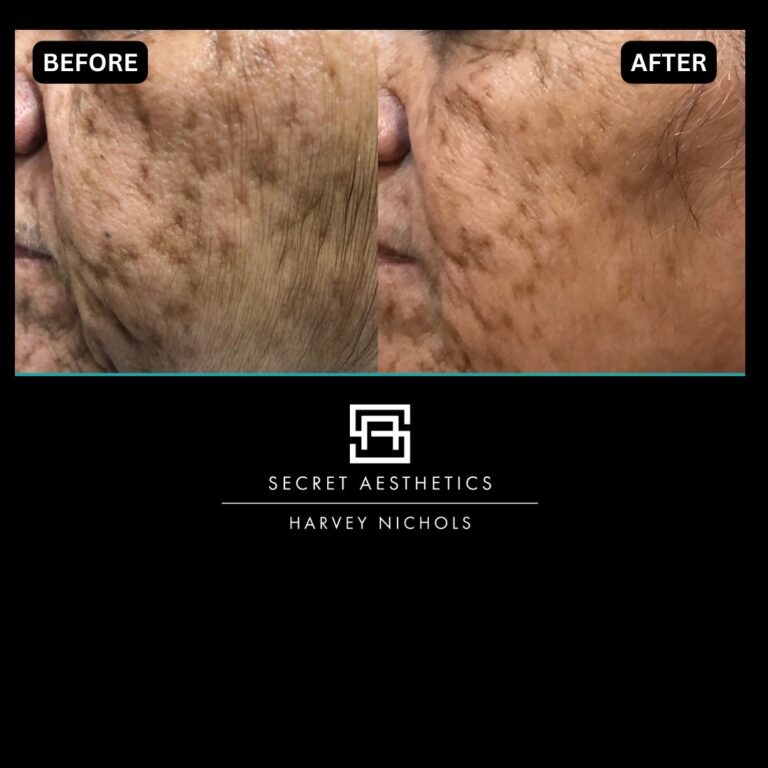 Radiofrequency microneedling results, Radiofrequency microneedling before and after, Radiofrequency microneedling treatment, Radiofrequency microneedling birmingham, aesthetics clinic birmingham, skin clinic birmingham, secret aesthetics birmingham, harvey nichols birmingham, the mailbox birmingham, the mailbox aesthetics clinic, the mailbox skin clinic, harvey nichols aesthetic clinic, harvey nichols skin clinic, General Anti-Ageing, Scars, Skin quality, laxity, texture and appearance Stretch Marks, stretch mark removal, sun damage removal, freckle removal, wrinkle treatment, skin resurfacing, scar removal