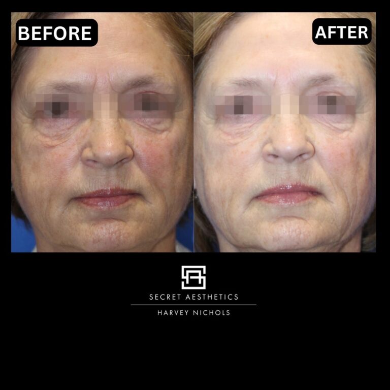 Radiofrequency microneedling results, Radiofrequency microneedling before and after, Radiofrequency microneedling treatment, Radiofrequency microneedling birmingham, aesthetics clinic birmingham, skin clinic birmingham, secret aesthetics birmingham, harvey nichols birmingham, the mailbox birmingham, the mailbox aesthetics clinic, the mailbox skin clinic, harvey nichols aesthetic clinic, harvey nichols skin clinic, General Anti-Ageing, Scars, Skin quality, laxity, texture and appearance Stretch Marks, stretch mark removal, sun damage removal, freckle removal, wrinkle treatment, skin resurfacing, scar removal