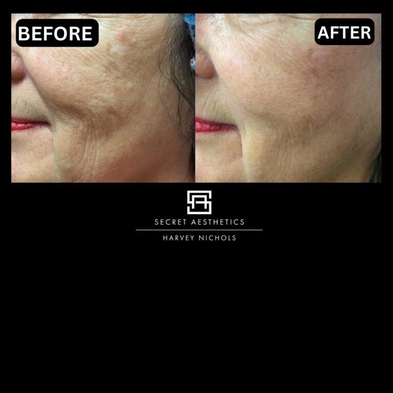 Radiofrequency microneedling results, Radiofrequency microneedling before and after, Radiofrequency microneedling treatment, Radiofrequency microneedling birmingham, aesthetics clinic birmingham, skin clinic birmingham, secret aesthetics birmingham, harvey nichols birmingham, the mailbox birmingham, the mailbox aesthetics clinic, the mailbox skin clinic, harvey nichols aesthetic clinic, harvey nichols skin clinic, General Anti-Ageing, Scars, Skin quality, laxity, texture and appearance Stretch Marks, stretch mark removal, sun damage removal, freckle removal, wrinkle treatment, skin resurfacing, scar removal