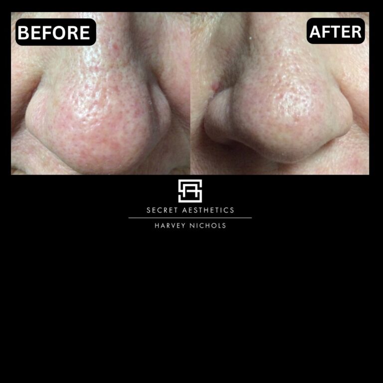 Radiofrequency microneedling results, Radiofrequency microneedling before and after, Radiofrequency microneedling treatment, Radiofrequency microneedling birmingham, aesthetics clinic birmingham, skin clinic birmingham, secret aesthetics birmingham, harvey nichols birmingham, the mailbox birmingham, the mailbox aesthetics clinic, the mailbox skin clinic, harvey nichols aesthetic clinic, harvey nichols skin clinic, General Anti-Ageing, Scars, Skin quality, laxity, texture and appearance Stretch Marks, stretch mark removal, sun damage removal, freckle removal, wrinkle treatment, skin resurfacing, scar removal