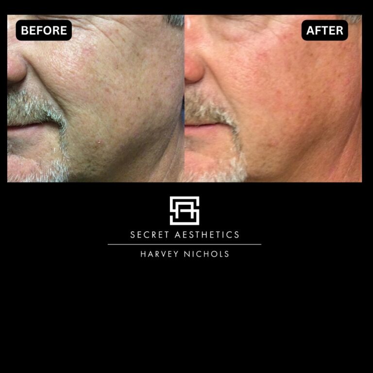 Radiofrequency microneedling results, Radiofrequency microneedling before and after, Radiofrequency microneedling treatment, Radiofrequency microneedling birmingham, aesthetics clinic birmingham, skin clinic birmingham, secret aesthetics birmingham, harvey nichols birmingham, the mailbox birmingham, the mailbox aesthetics clinic, the mailbox skin clinic, harvey nichols aesthetic clinic, harvey nichols skin clinic, General Anti-Ageing, Scars, Skin quality, laxity, texture and appearance Stretch Marks, stretch mark removal, sun damage removal, freckle removal, wrinkle treatment, skin resurfacing, scar removal