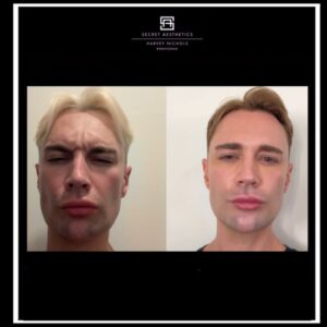 Before and after botox in Birmingham at Secret Aesthetics