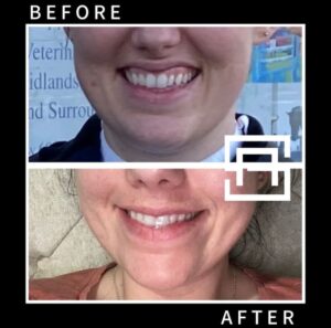 Gummy smile botox before and after Secret Aesthetics in Birmingham