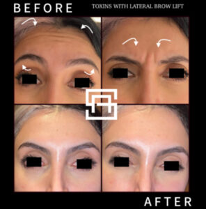 Before and after botox in Birmingham at Secret Aesthetics