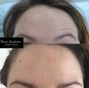 Before and after botox in Birmingham at Secret Aesthetics