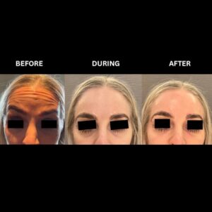 Before and after botox in Birmingham at Secret Aesthetics