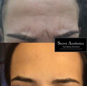Before and after botox in Birmingham at Secret Aesthetics