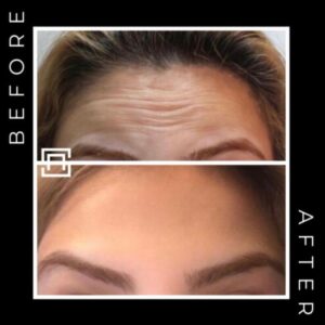 Before and after botox in Birmingham at Secret Aesthetics