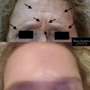 Before and after botox in Birmingham at Secret Aesthetics