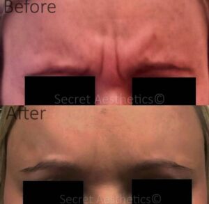 Before and after botox in Birmingham at Secret Aesthetics