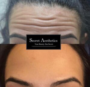Before and after botox in Birmingham at Secret Aesthetics