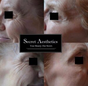 Before and after botox in Birmingham at Secret Aesthetics