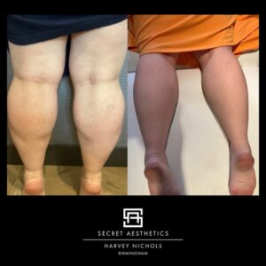 Before and after calf slimming botox in Birmingham at Secret Aesthetics