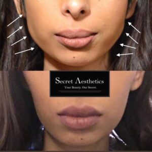 Face slim botox before and after in birmingham at Secret Aesthetics