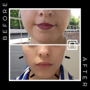 Face slim botox before and after in birmingham at Secret Aesthetics