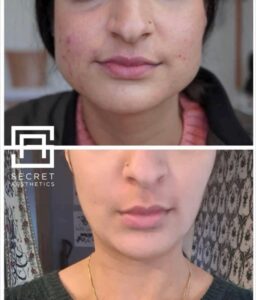 Face slim botox before and after in birmingham at Secret Aesthetics