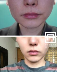 Face slim botox before and after in birmingham at Secret Aesthetics