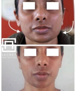 Face slim botox before and after in birmingham at Secret Aesthetics