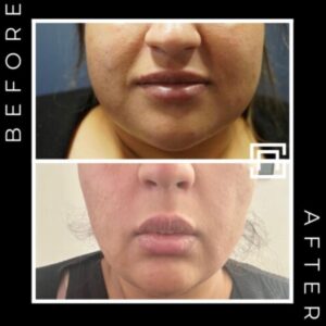 Face slim botox before and after in birmingham at Secret Aesthetics
