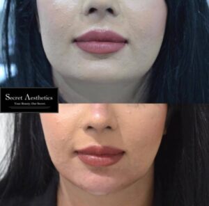 Face slim botox before and after in birmingham at Secret Aesthetics