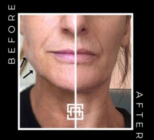 Face slim botox before and after in birmingham at Secret Aesthetics