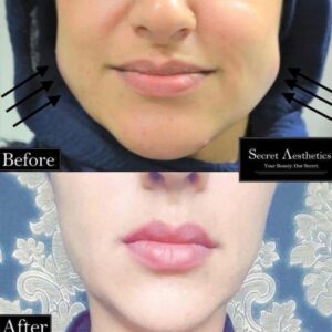 Masseter botox before and after birmingham