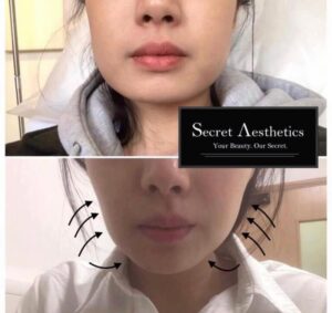 Masseter botox before and after birmingham