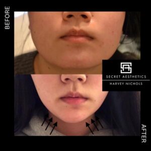 Masseter botox before and after birmingham