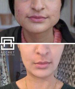 Masseter botox before and after birmingham