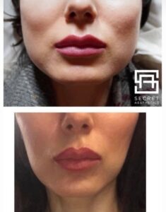 Masseter botox before and after birmingham