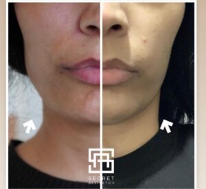 Masseter botox before and after birmingham