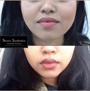 Masseter botox before and after birmingham