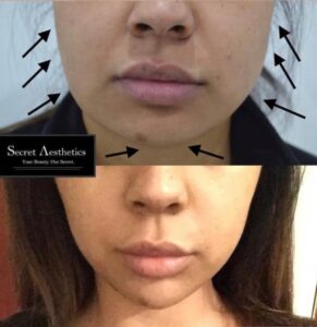 Masseter botox before and after birmingham