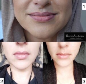 Masseter botox before and after birmingham