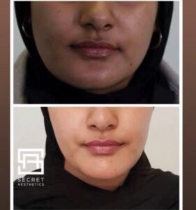 Masseter botox before and after birmingham
