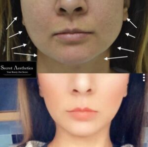 Masseter botox before and after birmingham