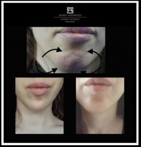 Chin botox before and after birmingham